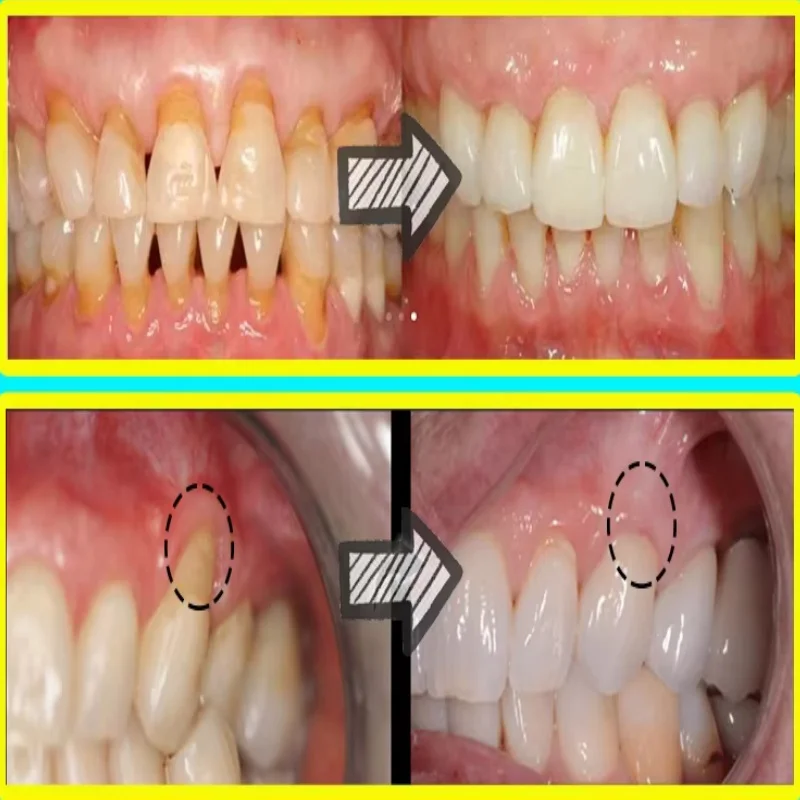 Quickly Repair Gum Serum Relie - Teeth Whitening With Baking Soda review and price