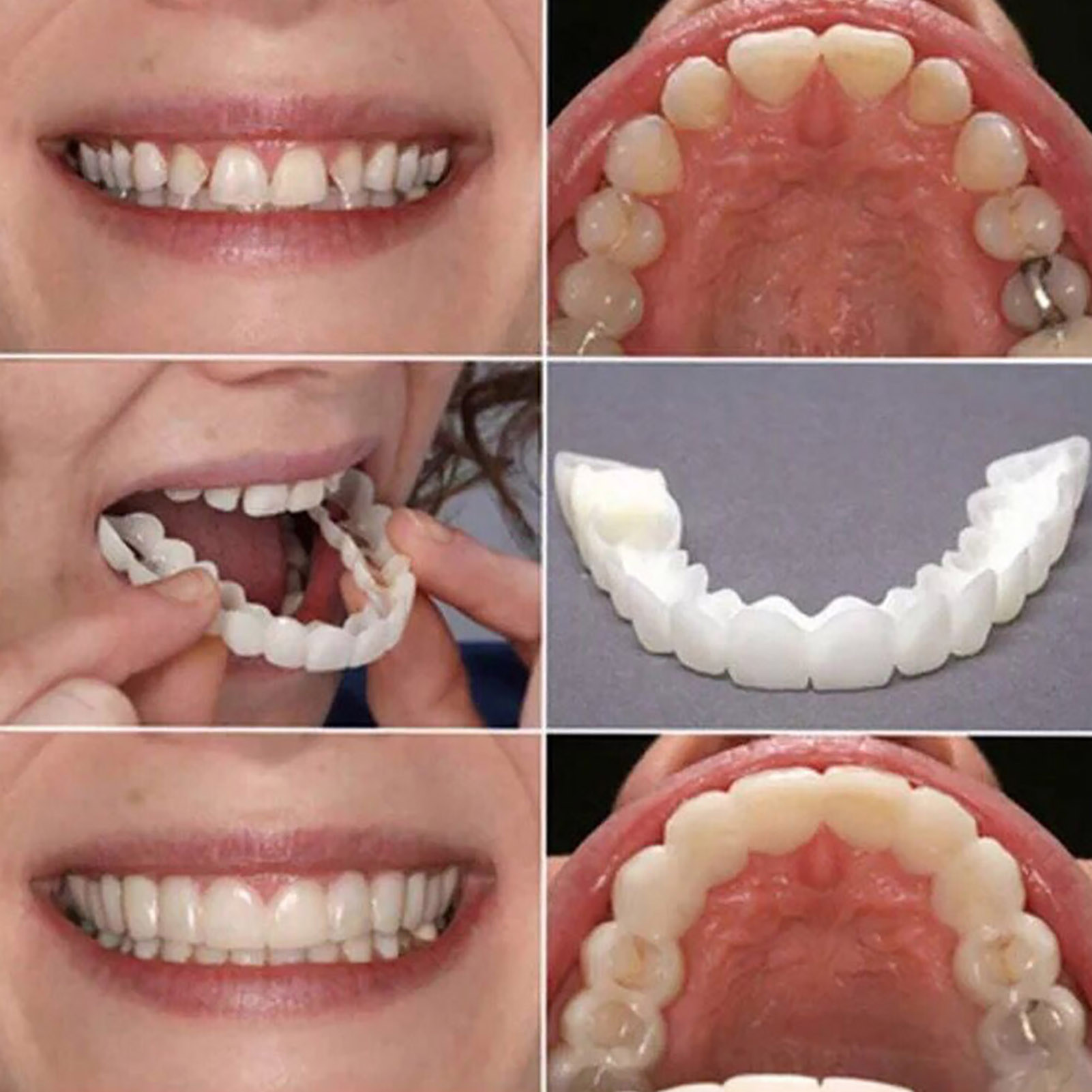 Hot Teeth Veneers Whitening De - Teeth Whitening With Braces review and price