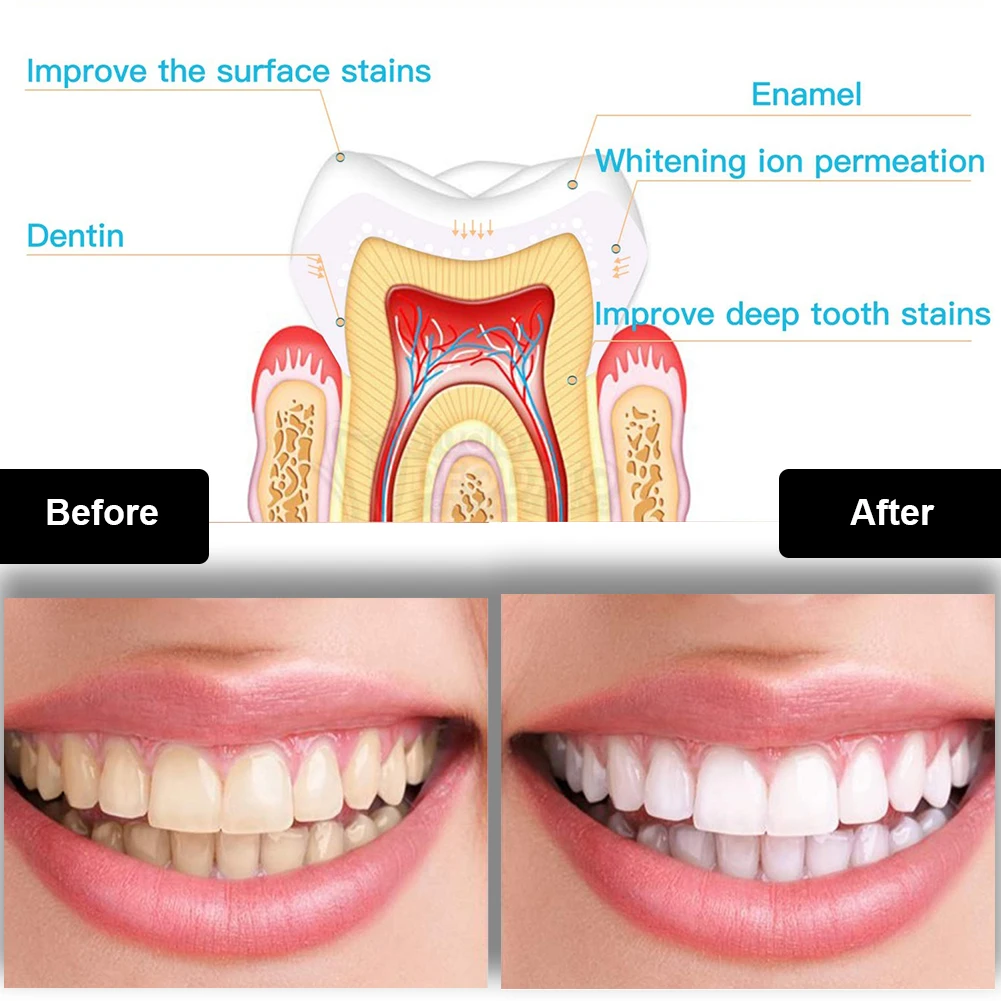 Dental Teeth Whitening Kit Min - Teeth Whitening Pens review and price
